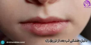 دلیل خشکی لب بعد از تزریق ژل