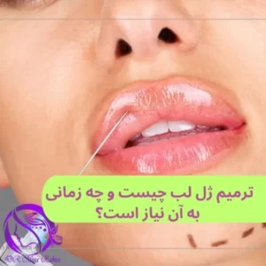 عکس ترمیم ژل لب / مطب دکتر مینا ربیعی