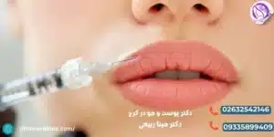 تزریق ژل لب قلبی برای چه کسانی مناسب