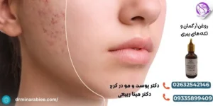 روغن آرگمان و لکه های پیری 