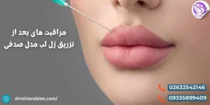 مراقبت های بعد از تزریق ژل لب مدل صدفی