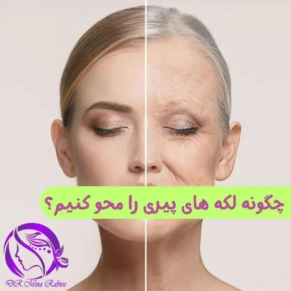 چگونه لکه های پیری را محو کنیم