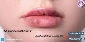 کاهش تورم و کبودی پس از تزریق ژل لب