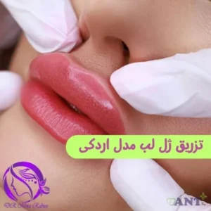 تزریق ژل لب مدل اردکی