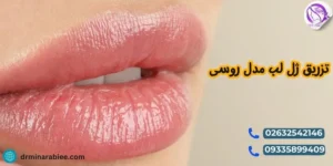 تزریق ژل لب مدل روسی