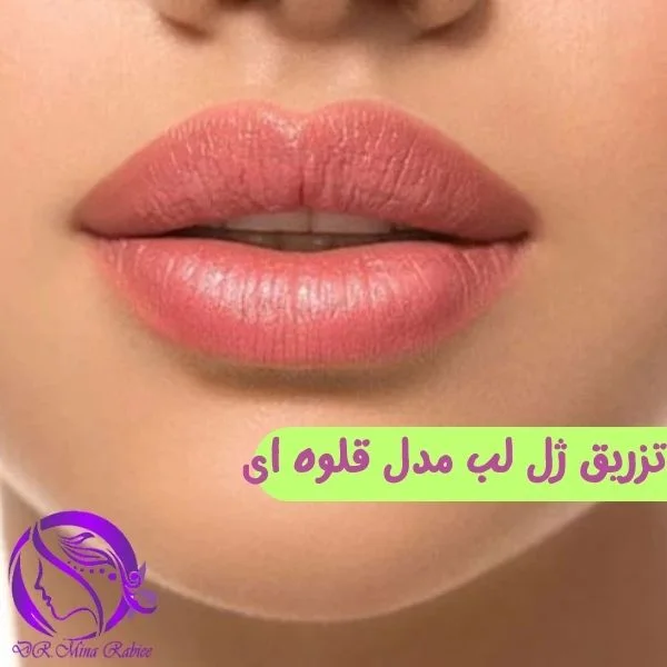 تزریق ژل لب مدل قلوه ای