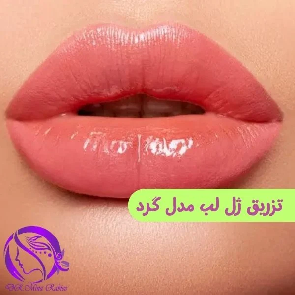 تزریق ژل لب مدل گرد