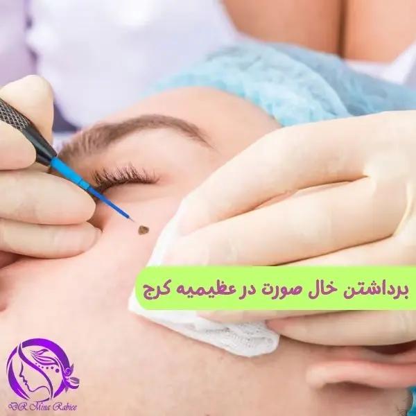 برداشتن خال صورت در عظیمیه کرج