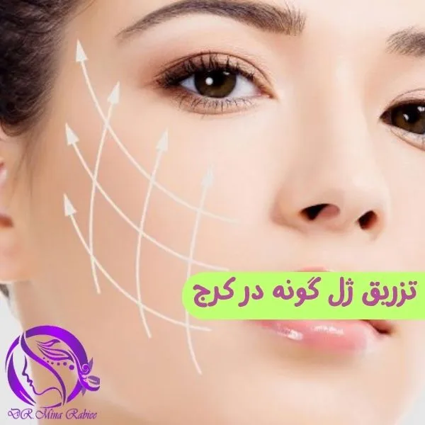 تزریق ژل گونه در کرج / مطب دکتر مینا ربیعی