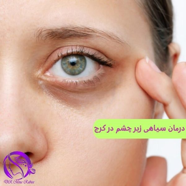 درمان سیاهی زیر چشم در عظیمیه کرج / مطب دکتر مینا ربیعی