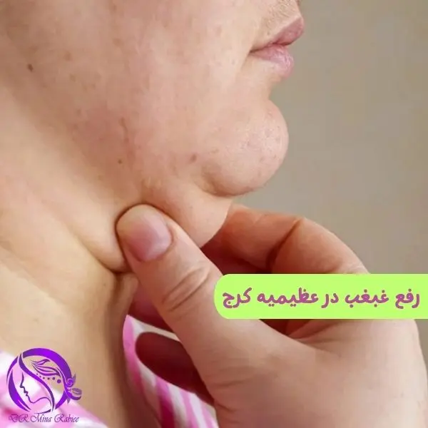 رفع غبغب در کرج/ رفع غبغب بدون جراحی