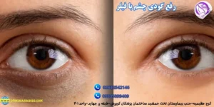 نمونه کار رفع تیرگی زیر چشم در مطب دکتر مینا ربیعی