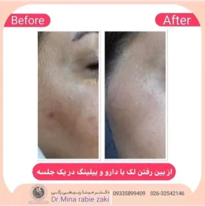 نمونه کار پیلینگ صورت در کرج